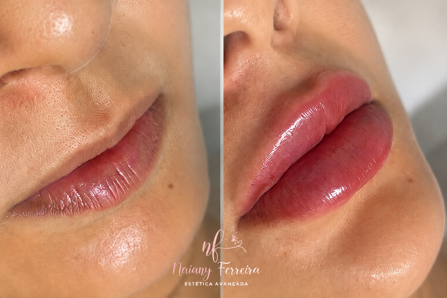 Resultado de harmonização facial