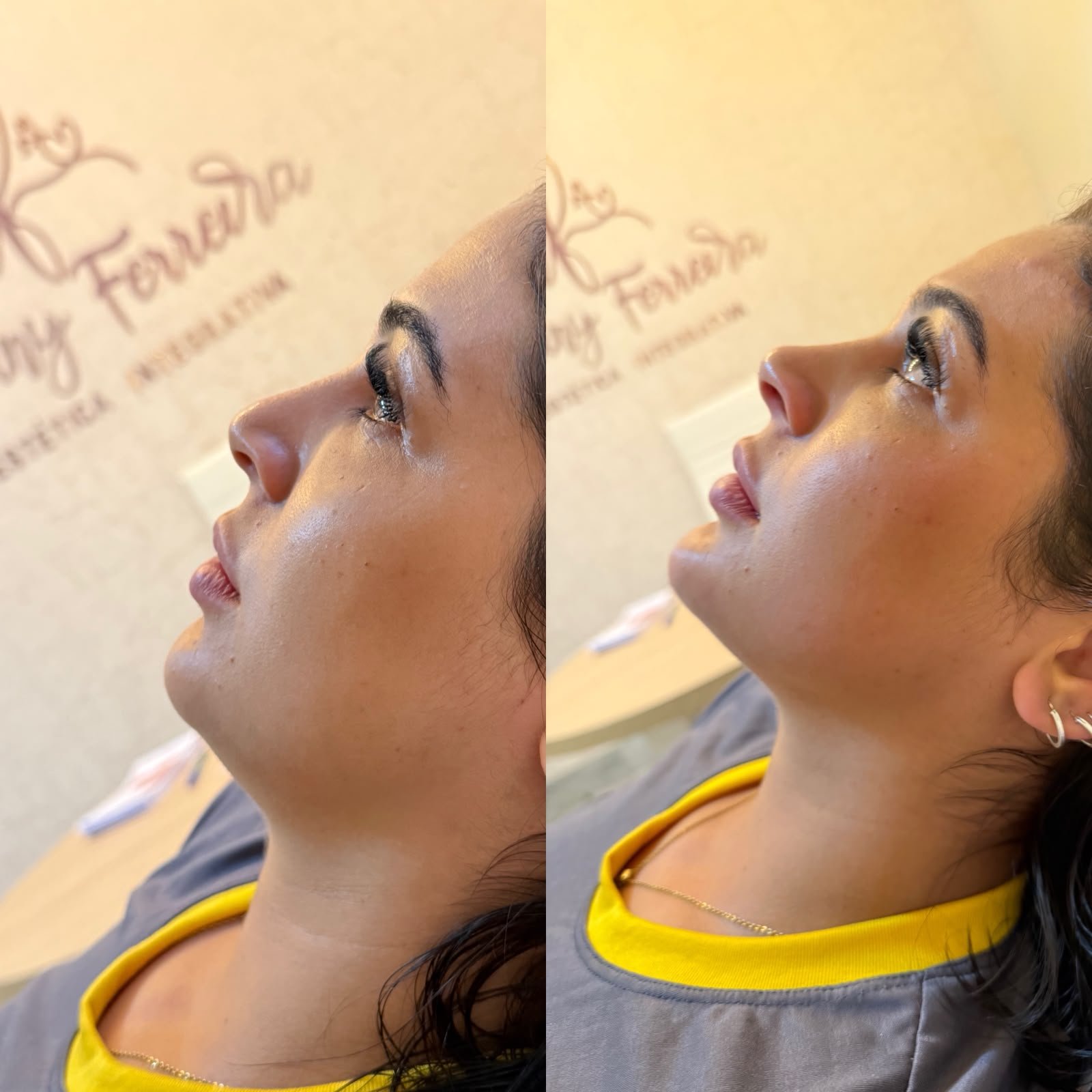 Resultado de perfil facial