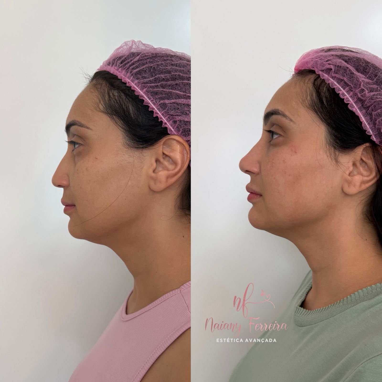 Resultado de harmonização facial